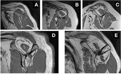 A lipid metabolite lipidomics assay for prediction and severity evaluation of rotator cuff injury